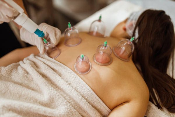 cupping therapy in Surrey